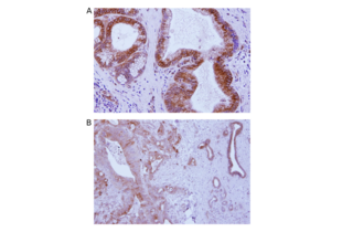 Immunohistochemistry on pancreatic adenocarcinoma (PDAC) FFPE tissue sections. The primary TMEM173 antibody ABIN3043423 was used 1:500 diluted in 5% normal Goat serum in PBS with a biotin-donkey-anti-rabbit IgG (H+L) secondary antibody. A. IHC staining of PDAC tissue from patient #1 at 400x magnification. B. IHC staining of PDAC tissue from patient #2 at 200x magnification.
