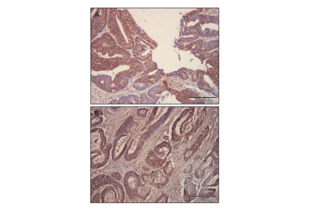 Immunohistochemical staining GLI2 with ABIN2777474 in well differentiated colorectal carcinoma (A) and poorly differentiated colorectal carcinoma (B). Localization of GLI2 is cytoplasmic and nuclear. Magnification 200x.