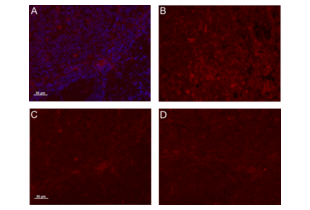 IF validation of osteoactivin antibody ABIN749093 on mouse brain tumor sections. A. ABIN749093 diluted 1:100 (red), DAPI counterstaining (blue). B. Dilution factor 1:50. C. Dilution factor 1:100. D. Dilution factor 1:200.
