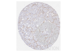 IHC staining of renal oncocytoma tissue with anti-collagen IV antibody ABIN5596835 diluted 1:300 shows dense collagen IV-positive membranes surrounding tumor cell nests.