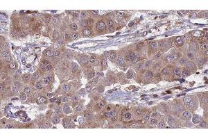 ABIN6276297 at 1/100 staining Human liver cancer tissue by IHC-P.