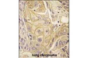 Formalin-fixed and paraffin-embedded human lung carcinoma tissue reacted with EphB2 antibody (ABIN391921 and ABIN2841731) , which was peroxidase-conjugated to the secondary antibody, followed by DAB staining. (EPH Receptor B2 antibody)
