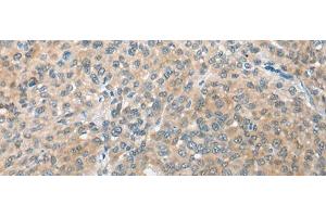 Immunohistochemistry of paraffin-embedded Human liver cancer tissue using CBR3 Polyclonal Antibody at dilution of 1:35(x200) (CBR3 antibody)