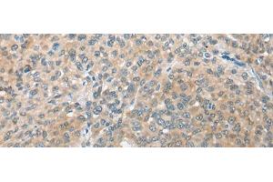 Immunohistochemistry of paraffin-embedded Human liver cancer tissue using CBR3 Polyclonal Antibody at dilution of 1:35(x200)