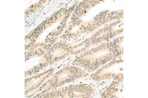 Immunohistochemistry analysis of paraffin-embedded human colon cancer using Isx (ABIN7074369) at dilution of 1: 2000 (ISX antibody)