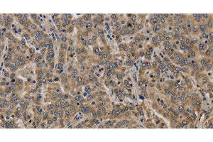 Immunohistochemistry of paraffin-embedded Human liver cancer tissue using KCNMB2 Polyclonal Antibody at dilution 1:40 (KCNMB2 antibody)
