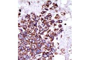 Formalin-fixed and paraffin-embedded human cancer tissue (hepatocarcinoma) reacted with the primary antibody, which was peroxidase-conjugated to the secondary antibody, followed by DAB staining. (CAMK1 antibody  (C-Term))