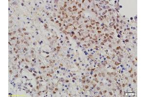 Formalin-fixed and paraffin embedded mouse cervical cancer labeled with Anti-MAT-1 Polyclonal Antibody, Unconjugated (ABIN686182) followed by conjugation to the secondary antibody and DAB staining (MTA1 antibody  (AA 601-715))