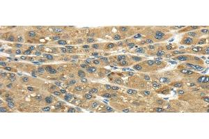 Immunohistochemistry of paraffin-embedded Human liver cancer tissue using UGT2B4 Polyclonal Antibody at dilution 1:45 (UGT2B4 antibody)