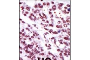 Formalin-fixed and paraffin-embedded human cancer tissue reacted with the primary antibody, which was peroxidase-conjugated to the secondary antibody, followed by AEC staining. (PKC epsilon antibody  (N-Term))