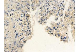 ABIN6263576 and ABIN6279584 at 1/100 staining human hepatocellular carcinoma by IHC-P.