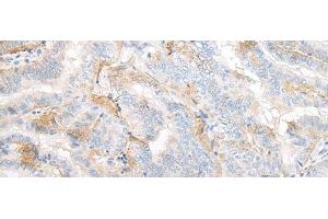 Immunohistochemistry of paraffin-embedded Human thyroid cancer tissue using TMEM248 Polyclonal Antibody at dilution of 1:25(x200) (C7orf42 antibody)