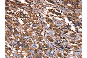 The image on the left is immunohistochemistry of paraffin-embedded Human thyroid cancer tissue using ABIN7190865(GREB1 Antibody) at dilution 1/40, on the right is treated with synthetic peptide. (GREB1 antibody)