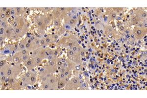 Detection of Bcl2L in Human Liver Cirrhosis Tissue using Polyclonal Antibody to B-Cell CLL/Lymphoma 2 Like Protein (Bcl2L) (BCL2L1 antibody  (AA 2-212))