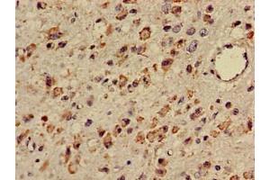Immunohistochemistry of paraffin-embedded human glioma using ABIN7171919 at dilution of 1:100 (TTC27 antibody  (AA 590-817))