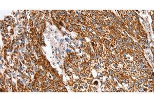 Immunohistochemistry of paraffin-embedded Human lung cancer using SSBP1 Polyclonal Antibody at dilution of 1:30 (SSBP1 antibody)