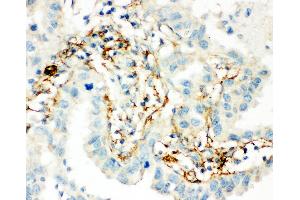 Anti-Transglutaminase 2 antibody, IHC(P) IHC(P): Human Lung Cancer Tissue (Transglutaminase 2 antibody  (C-Term))
