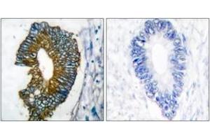Immunohistochemistry analysis of paraffin-embedded human lung carcinoma tissue, using Keratin 18 Antibody. (Cytokeratin 18 antibody  (AA 381-430))