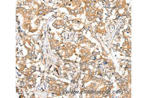 Immunohistochemistry of Human lung cancer using SIRT4 Polyclonal Antibody at dilution of 1:35 (SIRT4 antibody)