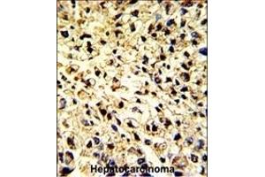 Formalin-fixed and paraffin-embedded human hepatocarcinoma with DCL-1 Antibody (Center), which was peroxidase-conjugated to the secondary antibody, followed by DAB staining. (DCL1 antibody  (AA 143-170))