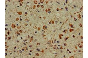 Immunohistochemistry of paraffin-embedded human glioma using ABIN7156227 at dilution of 1:100 (PFAS antibody  (AA 1064-1302))