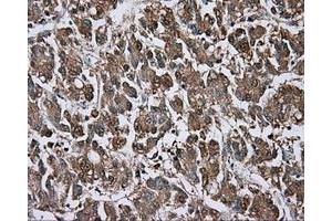 Immunohistochemical staining of paraffin-embedded Carcinoma of liver tissue using anti-BTK mouse monoclonal antibody. (BTK antibody)