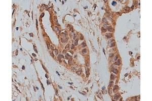 ABIN6273320 at 1/200 staining human colon cancer tissue sections by IHC-P. (SLC25A46 antibody  (N-Term))