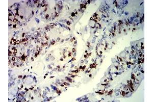 Immunohistochemical analysis of paraffin-embedded rectum cancer tissues using MKI67 mouse mAb with DAB staining. (Ki-67 antibody  (AA 1160-1493))