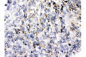 Perilipin 3 was detected in paraffin-embedded sections of human lung cancer tissues using rabbit anti- Perilipin 3 Antigen Affinity purified polyclonal antibody (Catalog # ) at 1 ? (PLIN3 antibody  (C-Term))