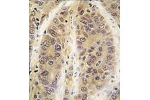 Formalin-fixed and paraffin-embedded human hepatocarcinoma tissue reacted with ADK antibody (C-term), which was peroxidase-conjugated to the secondary antibody, followed by DAB staining. (ADK antibody  (C-Term))