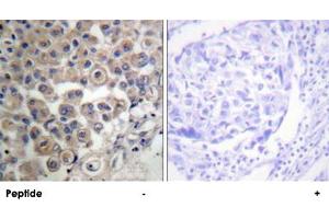 Immunohistochemistry analysis of paraffin-embedded human breast carcinoma tissue using PLCB3 polyclonal antibody . (PLCB3 antibody)