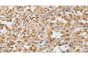Immunohistochemistry of paraffin-embedded Human thyroid cancer tissue using AMZ2 Polyclonal Antibody at dilution 1:40 (AMZ2 antibody)