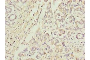 Immunohistochemistry of paraffin-embedded human pancreatic cancer using ABIN7144074 at dilution of 1:100 (ANAPC5 antibody  (AA 2-232))