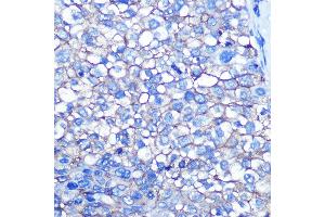 Immunohistochemistry of paraffin-embedded human liver cancer using CD13/ANPEP Rabbit mAb (ABIN7265525) at dilution of 1:100 (40x lens).