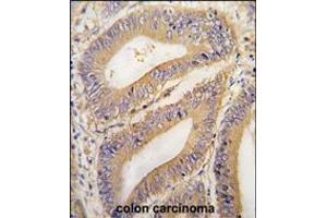 Formalin-fixed and paraffin-embedded human colon carcinoma tissue reacted with PHB2 Antibody , which was peroxidase-conjugated to the secondary antibody, followed by DAB staining. (Prohibitin 2 antibody  (N-Term))