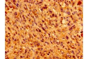 Immunohistochemistry of paraffin-embedded human melanoma using ABIN7156987 at dilution of 1:100 (IFT46 antibody  (AA 1-304))