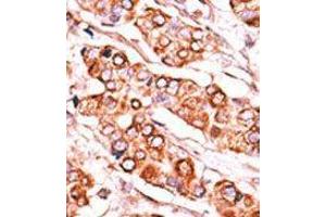 Formalin-fixed and paraffin-embedded human cancer tissue reacted with the primary antibody, which was peroxidase-conjugated to the secondary antibody, followed by DAB staining. (PDXK antibody  (C-Term))