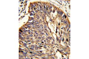 Formalin-fixed and paraffin-embedded human lung carcinoma reacted with MyD88 Antibody (Center), which was peroxidase-conjugated to the secondary antibody, followed by DAB staining. (MYD88 antibody  (AA 136-164))