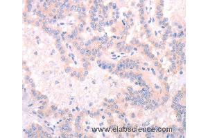 Immunohistochemistry of Human thyroid cancer using INA Polyclonal Antibody at dilution of 1:25