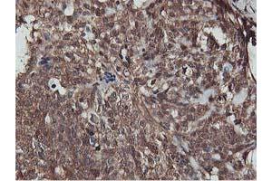 Immunohistochemical staining of paraffin-embedded Adenocarcinoma of Human breast tissue using anti-AKT1 mouse monoclonal antibody. (AKT1 antibody)