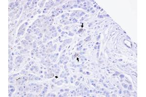 IHC-P Image Immunohistochemical analysis of paraffin-embedded MDAMB468 xenograft, using TRPM2, antibody at 1:100 dilution. (TRPM2 antibody  (N-Term))