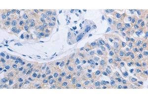 Immunohistochemistry of paraffin-embedded Human lung cancer tissue using HOXA6 Polyclonal Antibody at dilution 1:60