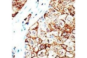 IHC analysis of FFPE human breast carcinoma tissue stained with the Ubiquilin1 antibody (Ubiquilin 1 antibody  (AA 296-326))
