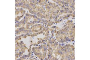 Immunohistochemistry of paraffin-embedded human thyroid cancer using XRCC2 antibody at dilution of 1:200 (x400 lens) (XRCC2 antibody)