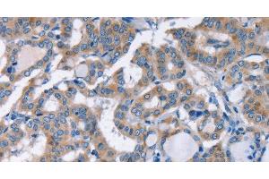 Immunohistochemistry of paraffin-embedded Human thyroid cancer using KCNQ5 Polyclonal Antibody at dilution of 1:30 (KCNQ5 antibody)