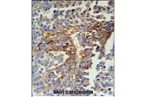 ARMC5 Antibody (C-term) (ABIN651593 and ABIN2840314) immunohistochemistry analysis in formalin fixed and paraffin embedded human skin carcinoma followed by peroxidase conjugation of the secondary antibody and DAB staining. (ARMC5 antibody  (C-Term))