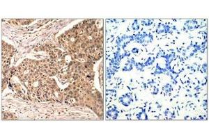 Immunohistochemical analysis of paraffin-embedded human breast carcinoma tissue using Paxillin(Phospho-Tyr118) Antibody(left) or the same antibody preincubated with blocking peptide(right). (Paxillin antibody  (pTyr118))