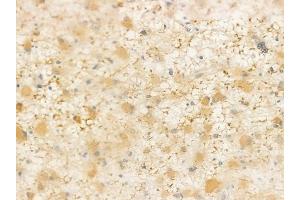 ABIN6257831 and ABIN6274416 at 1/100 staining human astrocytoma by IHC-P.