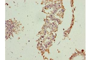 Immunohistochemistry of paraffin-embedded human breast cancer using ABIN7147338 at dilution of 1:100 (CRABP1 antibody  (AA 2-137))