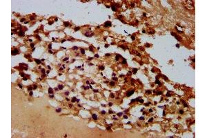 IHC image of ABIN7167931 diluted at 1:600 and staining in paraffin-embedded human melanoma performed on a Leica BondTM system. (ARHGAP15 antibody  (AA 1-154))